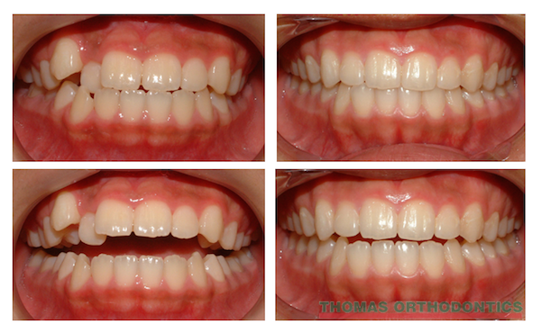 gapped teeth before and after braces