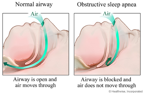 obstructive-sleep-apnea