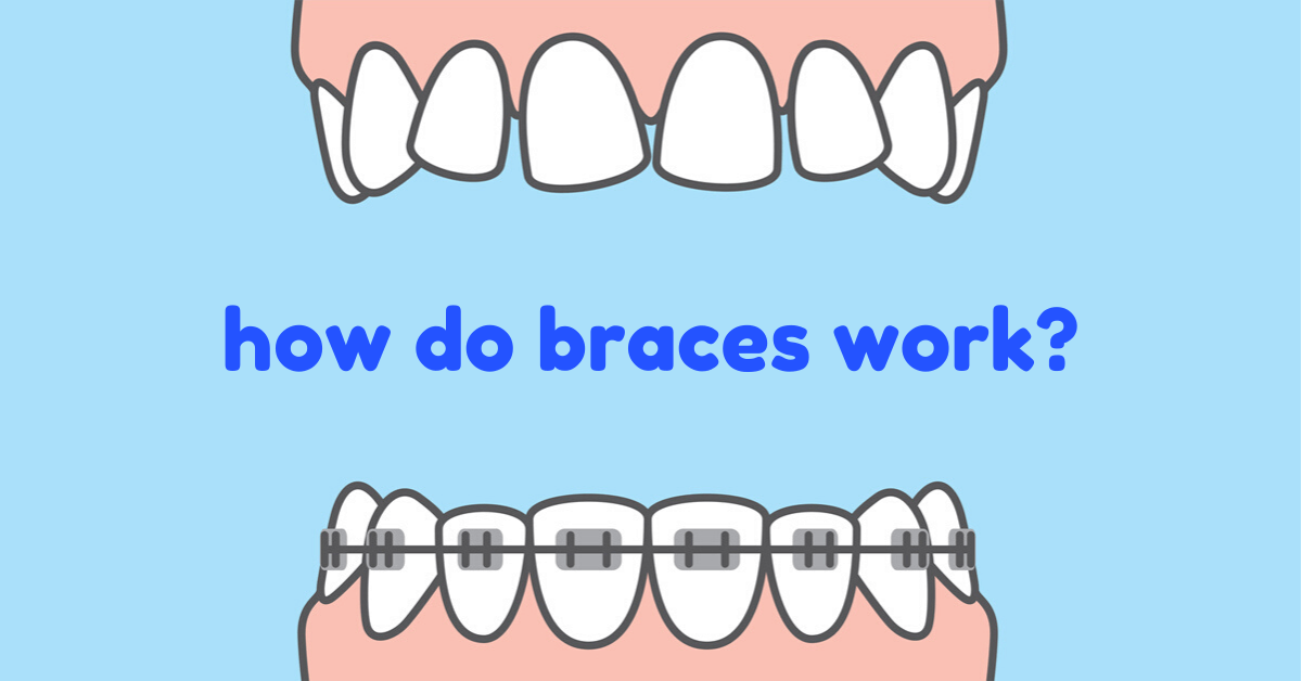 Mentor Braces