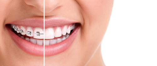 woman teeth and smile. Close up,half with braces