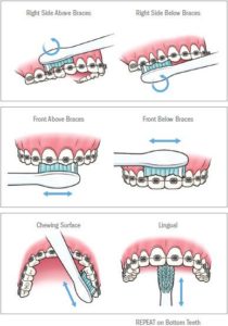 Oral Hygiene Hacks for Kids with Braces | Thomas Orthodontics