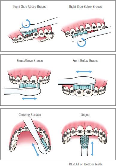 graphic showing appropriate brushing technique for teeth with braces
