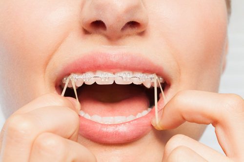 Woman using her fingers wearing orthodontic elastic bands over small hooks of clear brackets