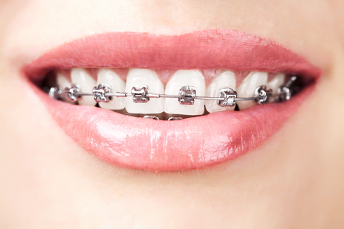 Metal braces: Traditional, Adult, Child, Teen, Kids, Cost - 