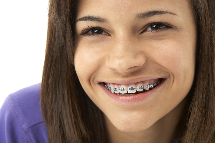 Whiten teeth with braces