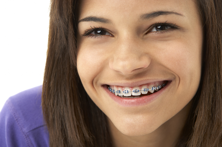 How To Keep Your Teeth White With Braces | Thomas Orthodontics