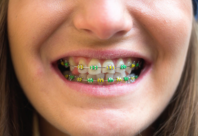 anise green braces braces color wheel