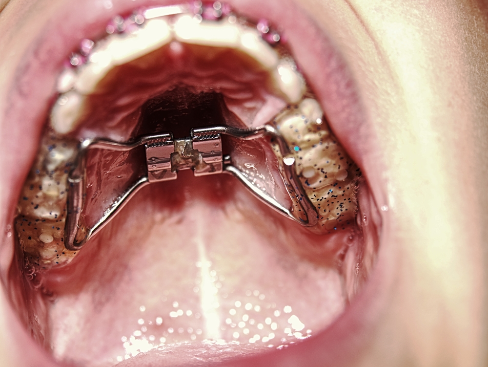 5 Common Questions About Palate Expanders Thomas Orthodontics