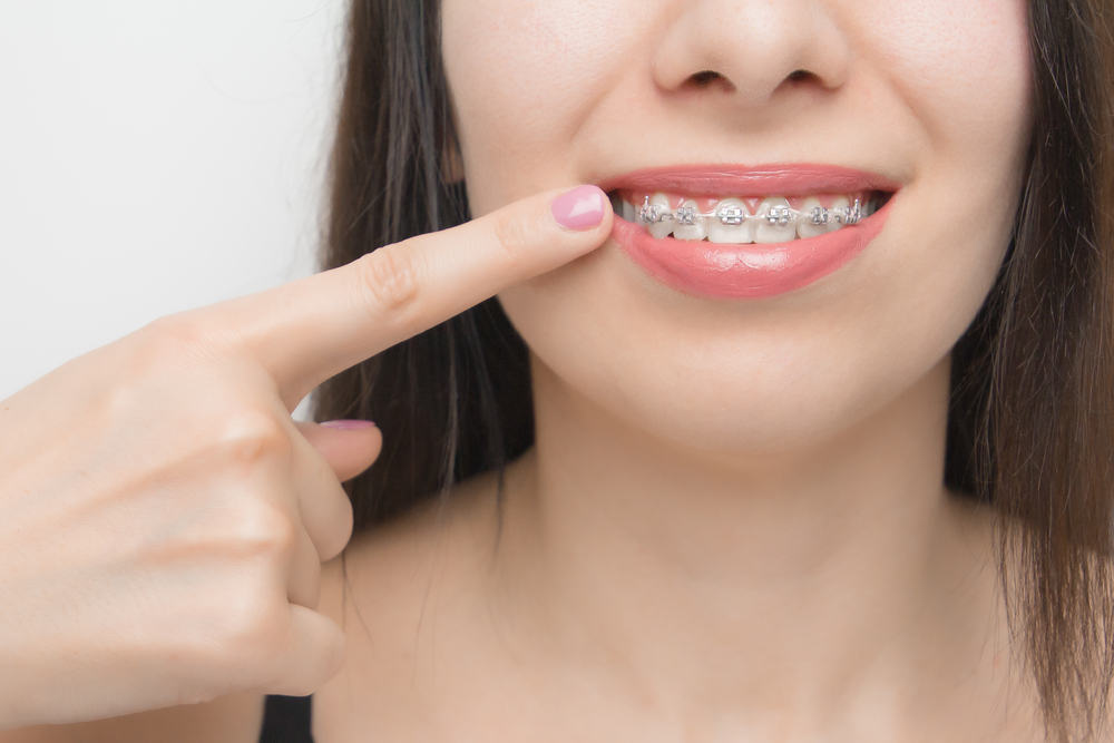Orthodontic wax tips