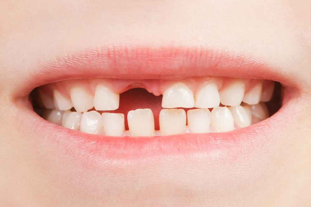 how-to-pull-a-loose-tooth-in-granbury-tx-granbury-dental-center