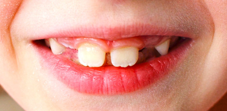 Can My Child Get Braces If They Still Have Baby Teeth