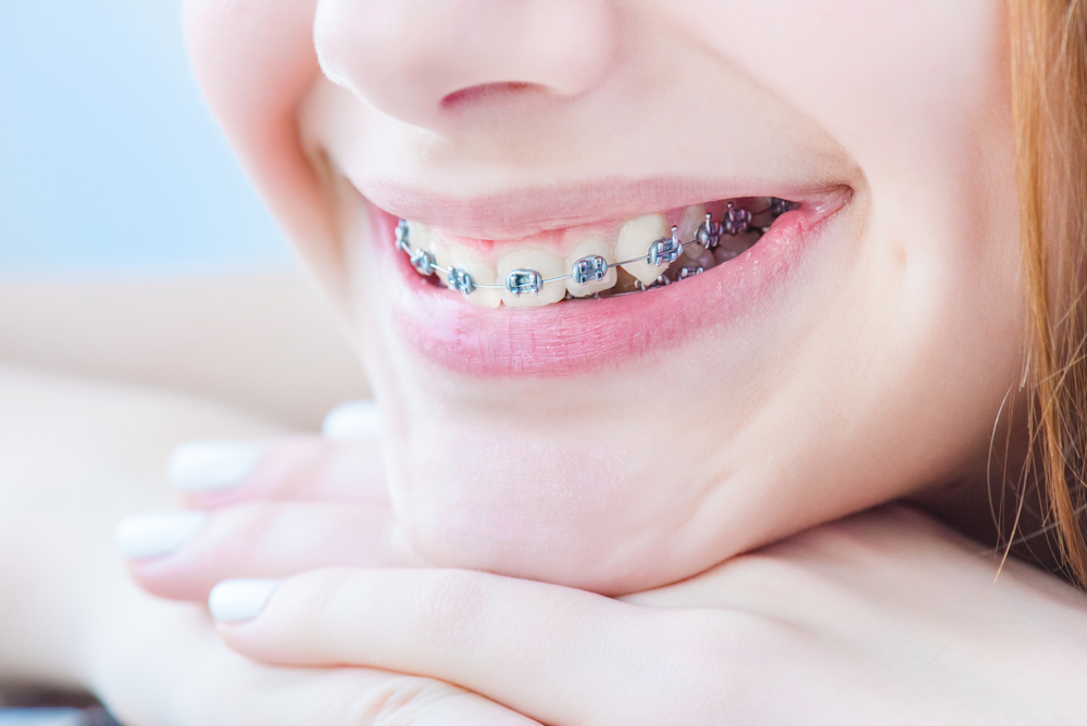 Braces Improve Total Mouth Health