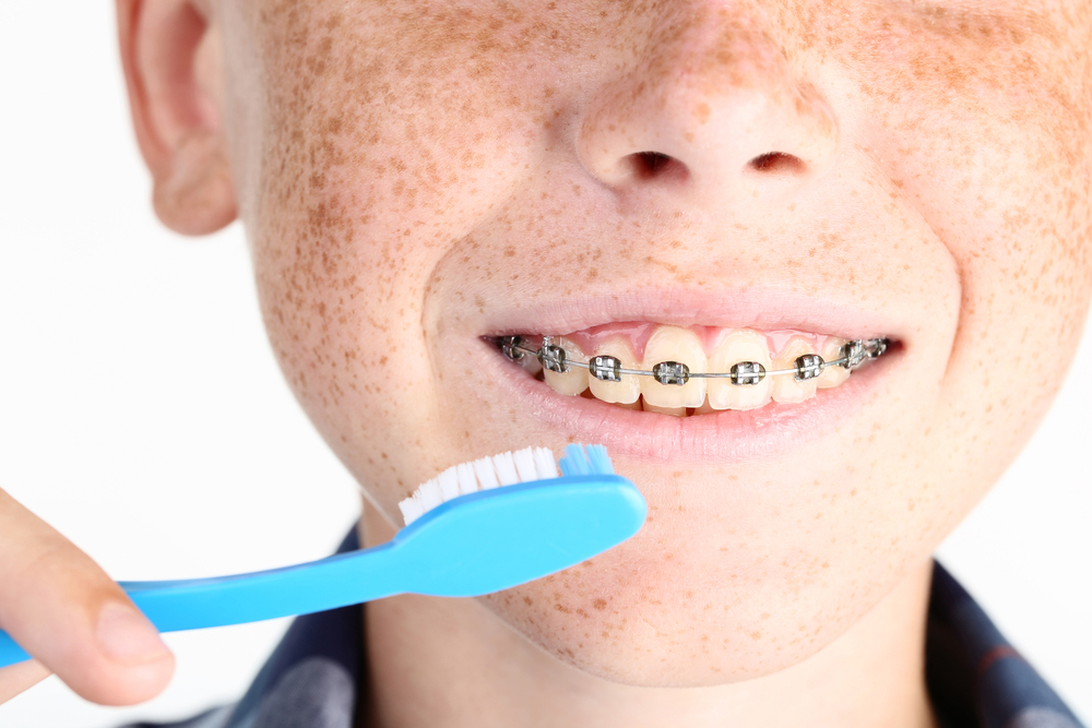Gingivitis in teens with braces