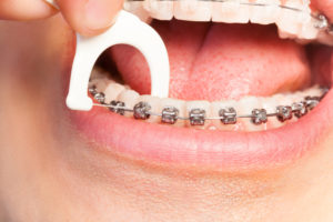 6 Secrets For Preventing Bad Breath With Braces - Thomas Orthodontics