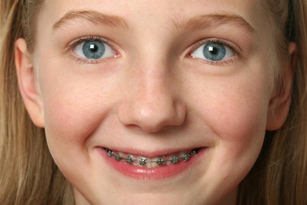 How to prepare a child for braces