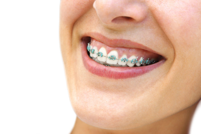 Teeth Whitening Treatments After Braces Thomas Orthodontics