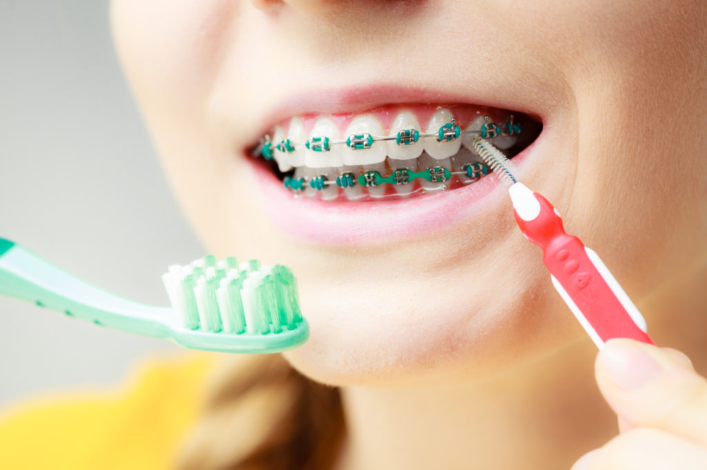Girl cleaning braces using interdental and traditional brush