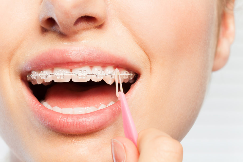 Orthodontic patient placing rubber bands on braces. 