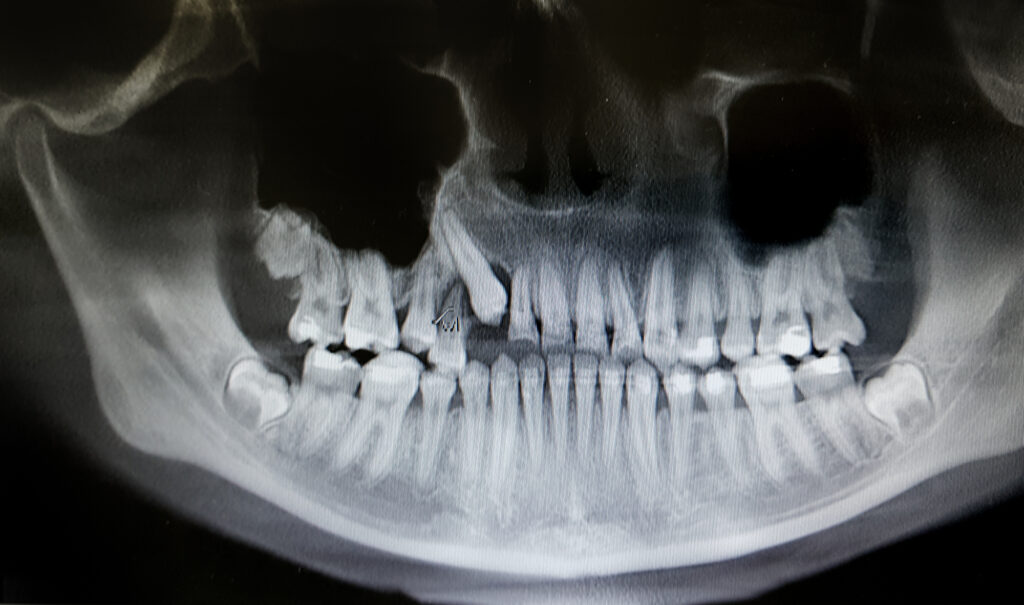 Dental x-ray showing braces and impacted teeth. 