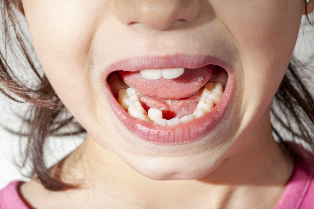 Child with misaligned teeth.
