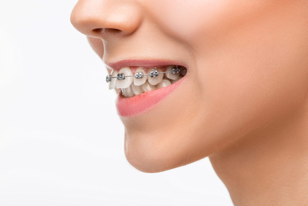 Woman with braces showing an overbite.