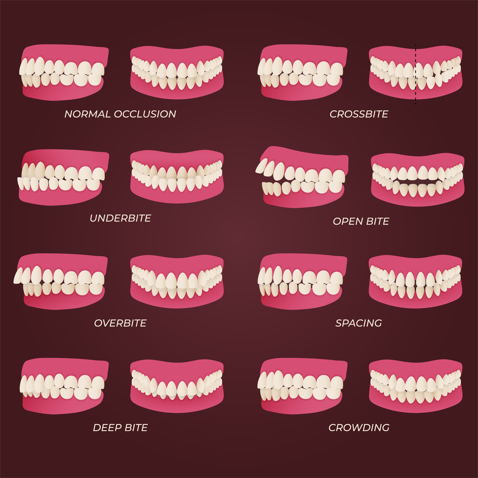 Types Of Malocclusions Understanding Your Smile s Alignment Thomas Types Of Malocclusions Understanding Your Smile s Alignment Thomas