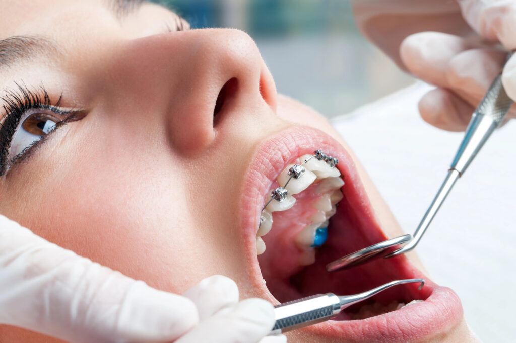 Close up of woman with braces getting dental cleaning. 