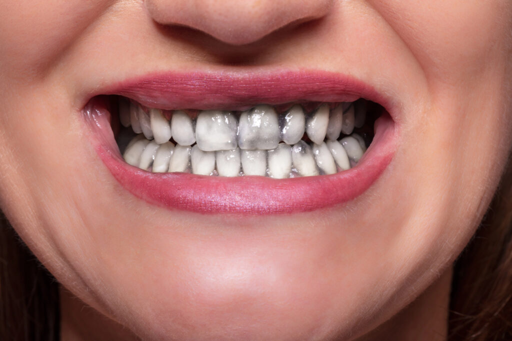 Close up of woman using charcoal teeth whitening hack.