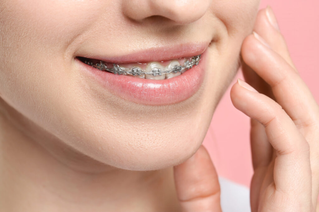 Close up of young lady with braces.