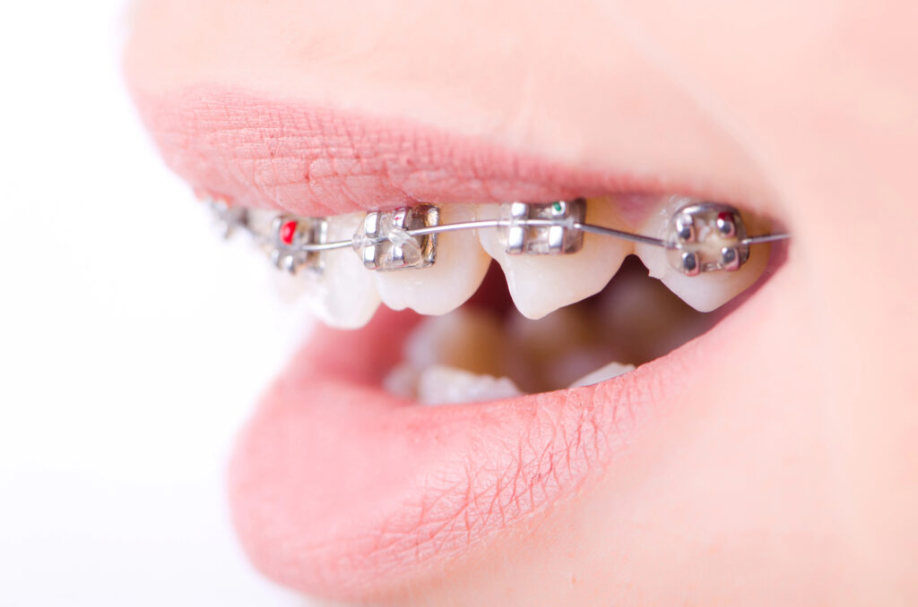 Close-up of braces.