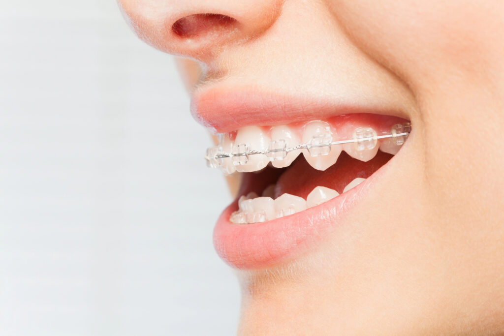 Close up of woman with modern clear braces