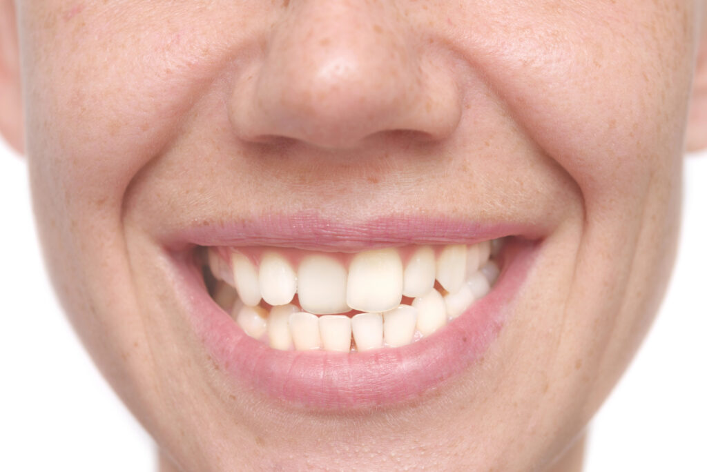 Close up of adult with misaligned teeth