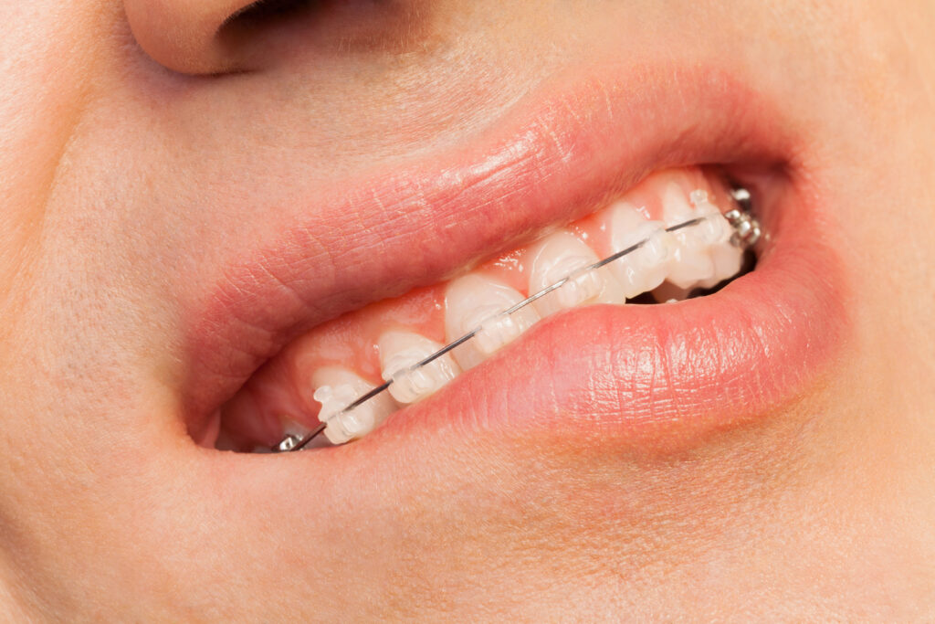 Person with braces biting lip